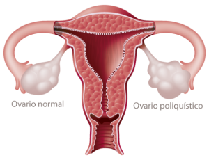 ovario-poliquistico
